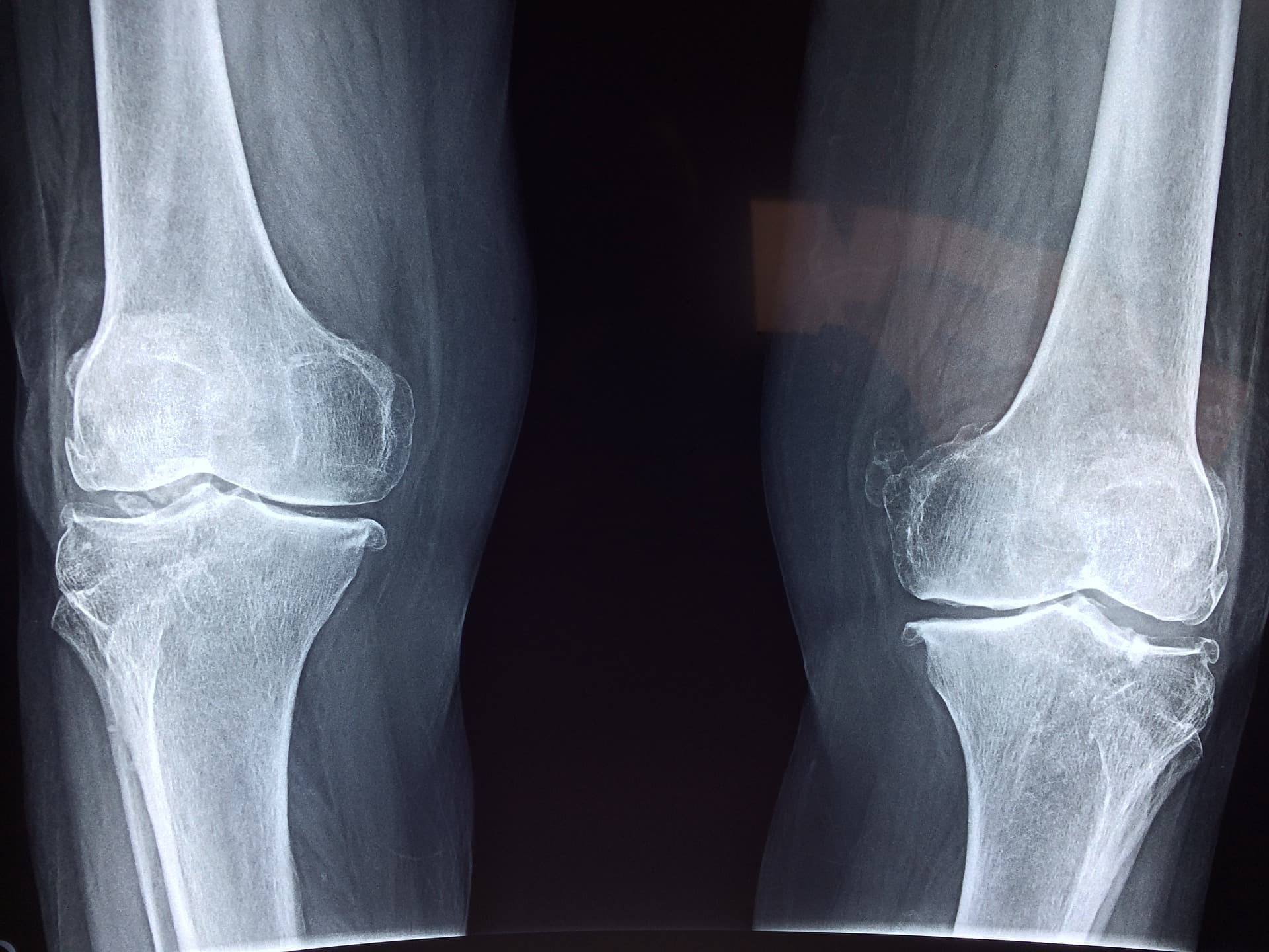 Could a once-abandoned obesity drug be revived in osteoporosis?