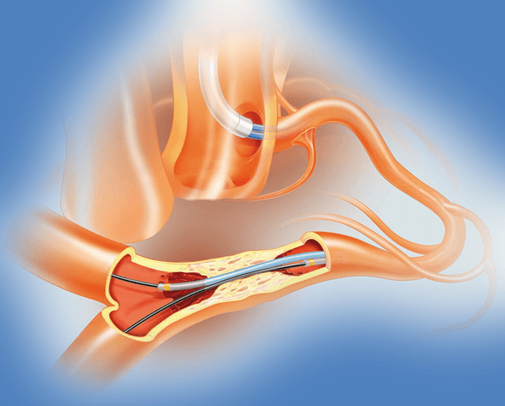 Microcatheter market to be worth $304.5m by 2026, says study