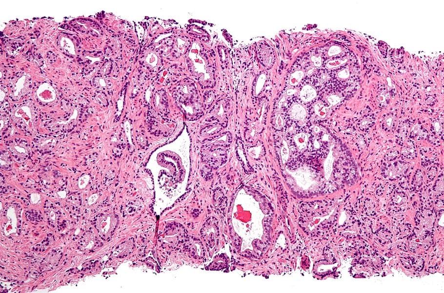 Sophiris slides on prostate cancer data but vows to press on