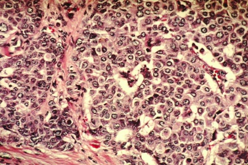 Tackling triple-negative breast cancer by blocking 2 key survival pathways